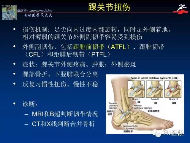 脚踝扭伤可大可小,有可能胫腓骨双骨折,比如冬奥会短道速滑冠军王蒙.